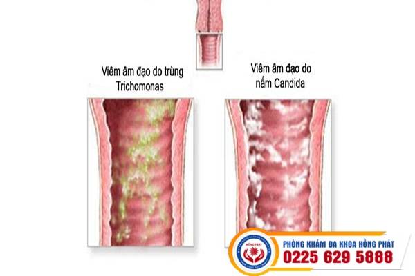 Âm đạo ra dịch đen có sao không?