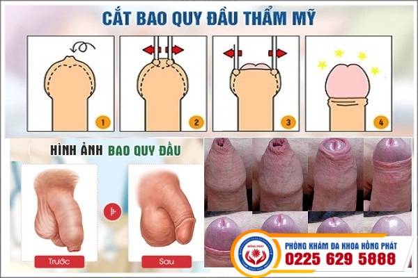 hinh-anh-truoc-va-sau-khi-cat-bao-quy-dau