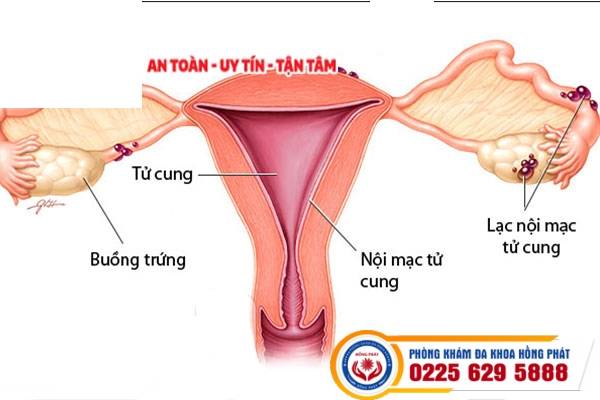 Kinh nguyệt vón cục là bệnh gì? Bác sĩ chuyên khoa tư vấn