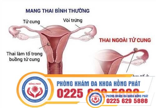 Mổ thai ngoài tử cung như thế nào có nguy hiểm không?