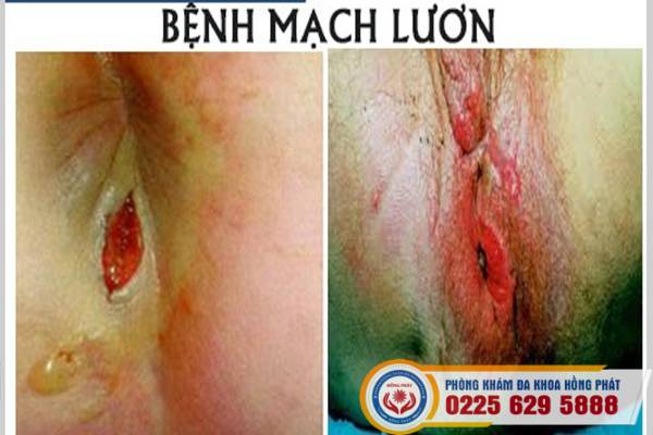 benh-mach-luon