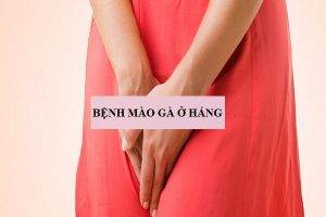 Cách điều trị bệnh mào gà ở háng hiệu quả nhất hiện nay