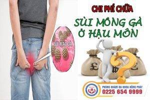 Chi phí điều trị sùi mồng gà ở hậu môn là bao nhiêu?