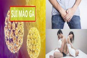 Bệnh mào gà ở dương vật và cách điều trị hiệu quả