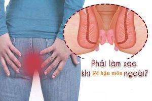 Lòi hậu môn là bị bệnh gì có nguy hiểm không?