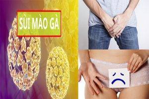 Những dấu hiệu nhận biết sùi mào gà ở vùng kín