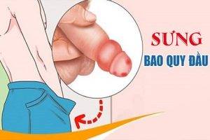 Cách chữa sưng bao quy đầu hiệu quả