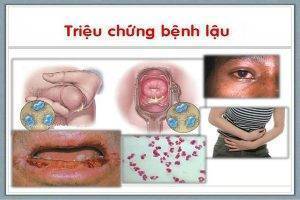 Bệnh lậu mãn tính có chữa được không?