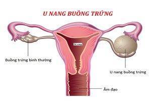 Triệu chứng bệnh u nang buồng trứng chị em nên biết sớm