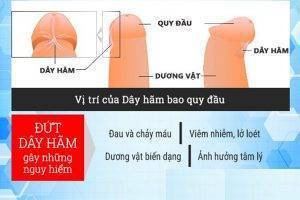 Cần phải làm gì khi bị đứt dây hãm bao quy đầu?