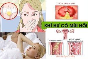 Khí hư có mùi hôi và những điều nữ giới nên biết