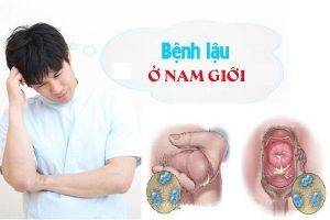 Bệnh lậu ở nam giới nguyên nhân triệu chứng và cách hỗ trợ điều trị