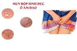 Hỗ trợ điều trị mụn rộp sinh dục ở âm đạo như thế nào?