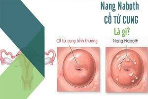 Nang Naboth cổ tử cung là bệnh nguy hiểm như thế nào?