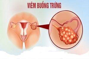 Viêm buồng trứng là bệnh gì nguyên nhân và cách chữa