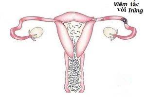 Nguyên nhân gây viêm tắc vòi trứng và cách điều trị
