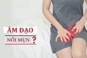 Nổi mụn âm đạo là dấu hiệu bệnh gì?