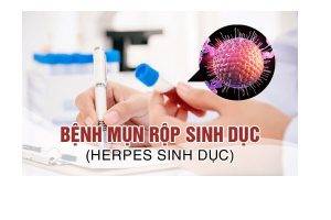 Địa chỉ chữa mụn rộp sinh dục uy tín hiệu quả