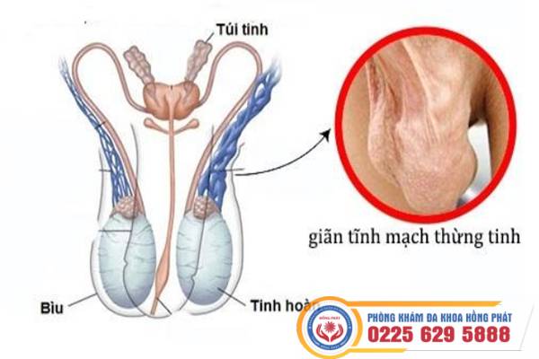 gian-tinh-mach-thung-tinh