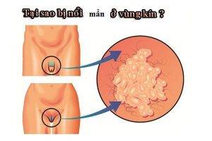 Nổi mẩn sinh dục nam là bệnh gì nguy hiểm không?