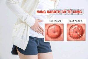 Cách điều trị nang naboth tử cung hiệu quả