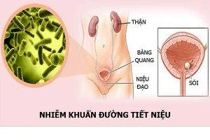 Nhiễm khuẩn đường tiết niệu và cách điều trị hiệu quả