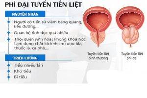 Dấu hiệu nhận biết phì đại tuyến tiền liệt