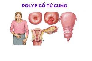 Cách điều trị polyp tử cung hiệu quả an toàn