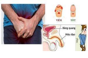 Rát bao quy đầu là bị bệnh gì nguy hiểm không?