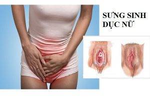 Sưng bộ phận sinh dục nữ nguyên nhân do đâu?