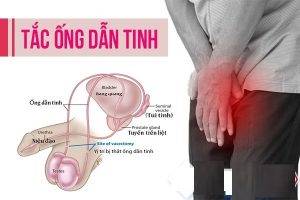 Tắc ống dẫn tinh nguyên nhân dấu hiệu và cách điều trị