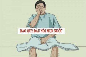 Nổi mụn nước bao quy đầu là bị bệnh gì?