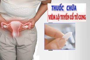 Thuốc chữa viêm lộ tuyến cổ tử cung hiệu quả