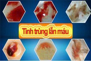 Tinh trùng màu đỏ là bị bệnh gì?