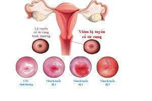 Biểu hiện viêm lộ tuyến cổ tử cung chị em nên biết