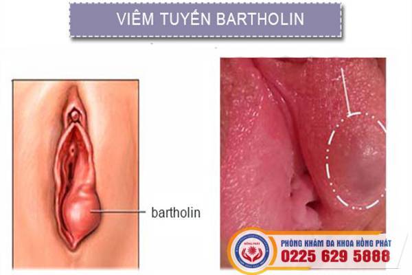 viem-tuyen-bartholin