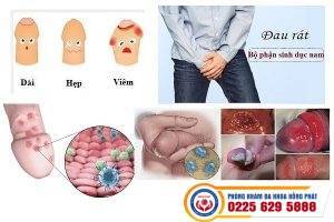 Các bệnh dương vật thường gặp ở nam giới – Hỗ trợ điều trị hiệu quả tại Hồng Phát