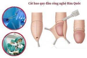 Cắt bao quy đầu bằng những phương pháp nào?