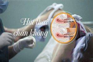 Tìm hiểu phương pháp hút thai chân không