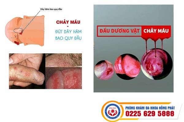 nguyen-nhan-chay-mau-duong-vat