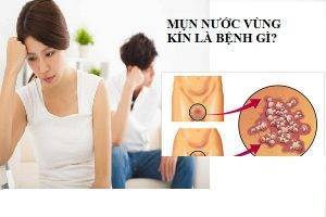 Mụn nước vùng kín là bị bệnh gì có nguy hiểm không?