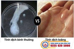 Tinh trùng loãng là như thế nào – chữa trị ra sao?