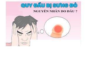 Sưng bao quy đầu là dấu hiệu của bệnh gì?