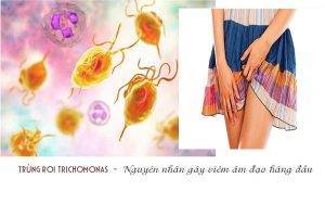 Nấm Trichomonas gây viêm âm đạo nguy hiểm như thế nào?