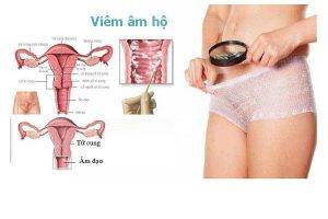 Cảnh báo: Những điều bạn phải biết về viêm âm hộ