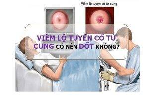 Phương pháp đốt điện viêm lộ tuyến cổ tử cung có hiệu quả không?