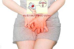 Xuất huyết tử cung nguyên nhân do đâu?