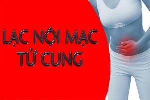 Bệnh lý phụ khoa: Lạc nội mạc tử cung