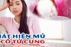 Phát hiện có mủ từ cổ tử cung, chị em nên làm gì?