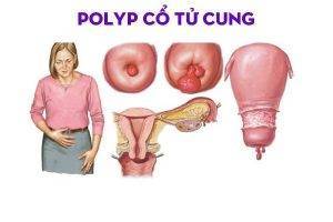 Polyp cổ tử cung và những điều cần chú ý